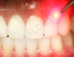 laser-dentistry-1